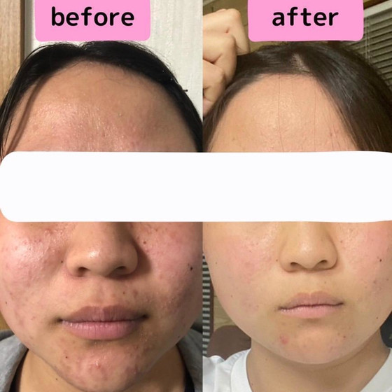 before after